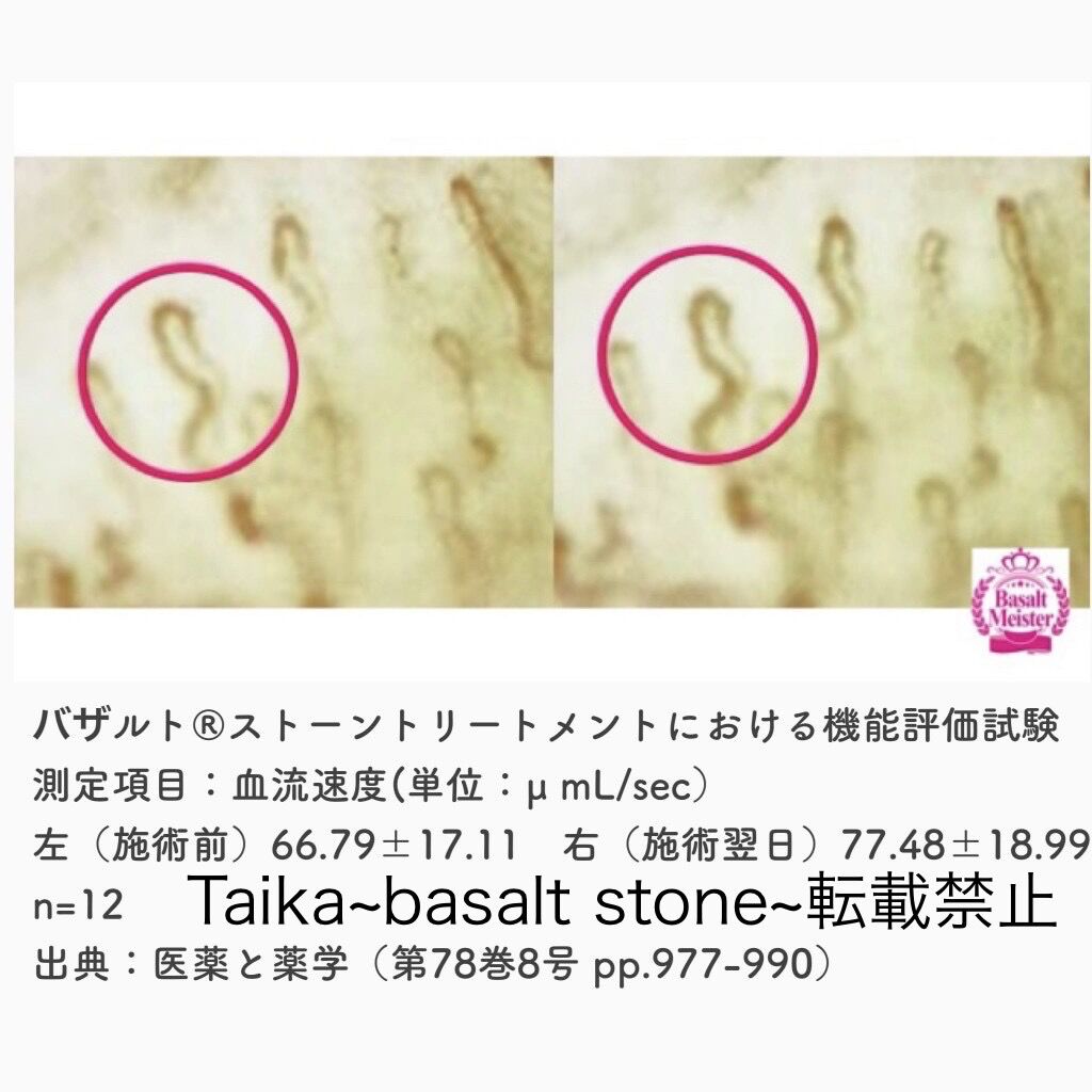 バザルト®ストーントリートメント前後の末端血流速度の変化を示す検証画像