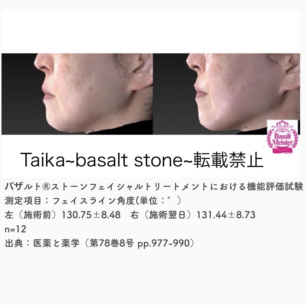 バザルト®ストーンフェイシャルトリートメント前後のフェイスライン角度の変化を示す検証画像