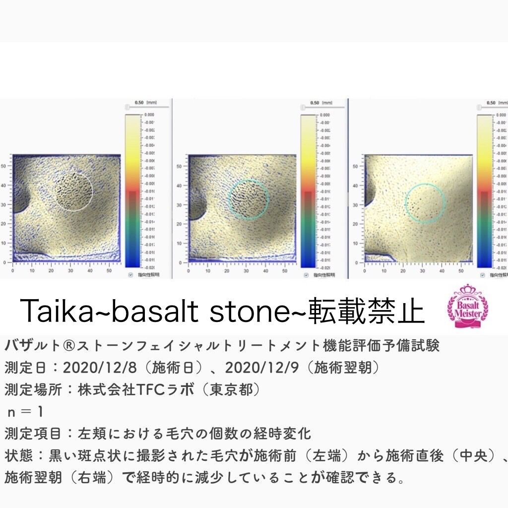 バザルト®ストーンフェイシャルトリートメント前後の毛穴の個数の変化を示す検証画像