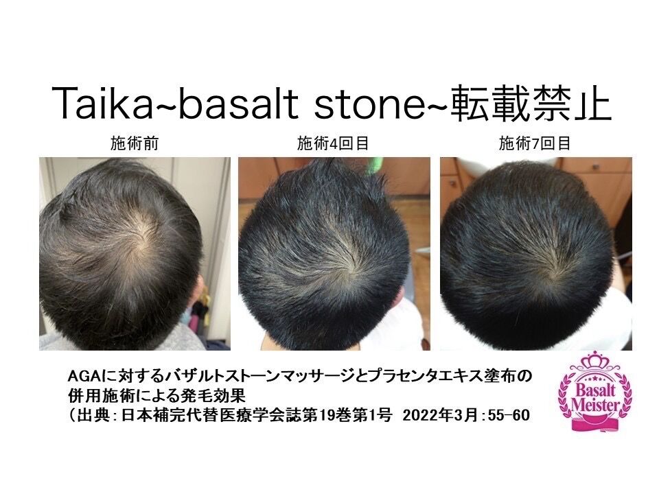 バザルト®ストーンマッサージとプラセンタエキス塗布の併用施術における毛髪検査(施術前・4回目・7回目)