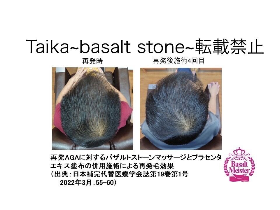 再発AGAに対するバザルト®ストーンマッサージとプラセンタエキス塗布の併用施術による再発毛効果(再発時・再発後施術4回目)